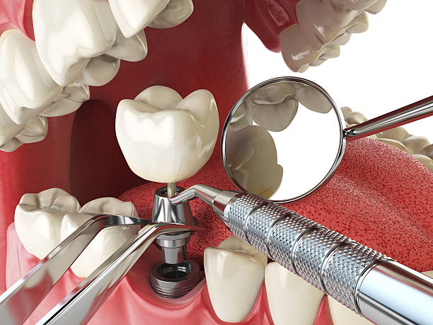 Best Emergency Denture Repair in Maltby, WA